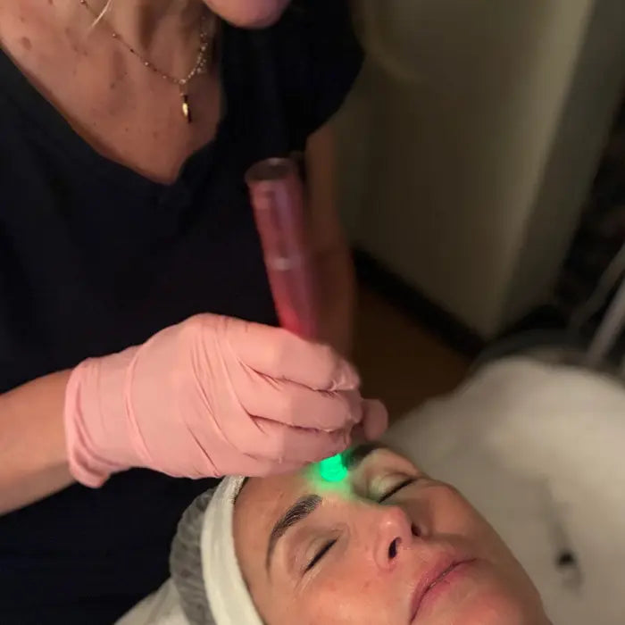 Exosomas con dermapen